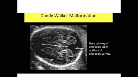 Dandy Walker Dandy Walker Ultrasound