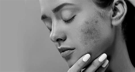 Acne Scarring Dermis Advanced Skin Care Ottawa