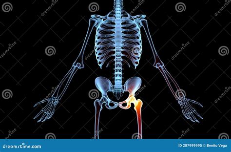 X Ray Human Skeleton With Hip Femur Orange Highlight Indicating Pain