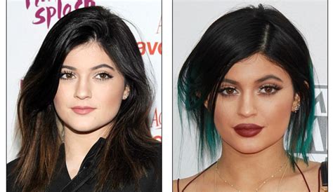 Utah Facial Plastic Surgeon Weighs In On Kylie Jenners Lips
