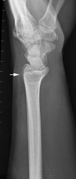 Radiography Of Subtle Wrist Fractures Wikiradiography