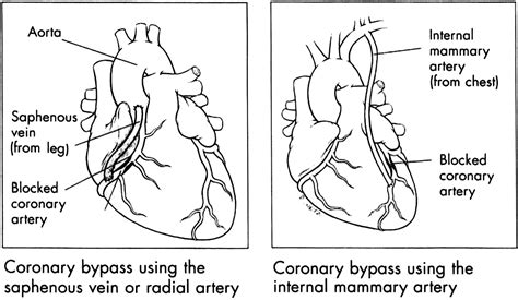 On Pump And Off Pump Coronary Artery Bypass Grafting Circulation