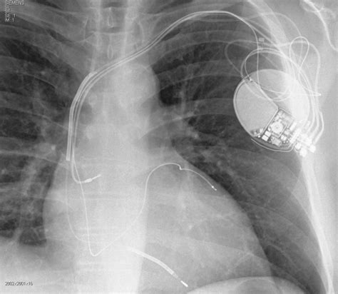 Early Complications After Pacemaker Implantations Intechopen