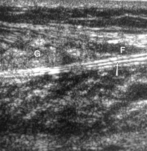 Sonography Of The Painful Calf Differential Considerations Ajr