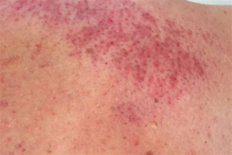 Pinprick Red Dots On Skin Not Itchy Causes And Treatments Skin Care