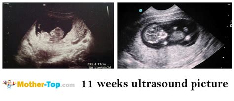 11 Weeks Pregnant — Fetal Development And Mothers Health