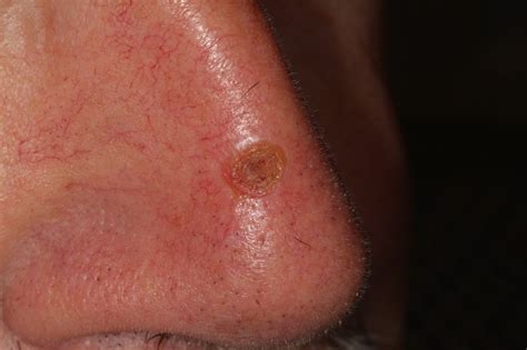 Basal Cell Carcinoma On The Nose Skin Cancer Or Mole