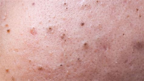 How To Treat And Remove Blackheads Reviewed