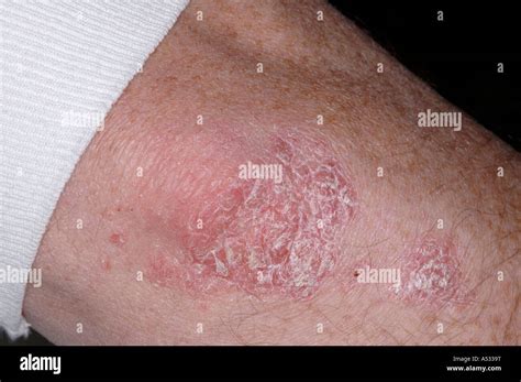 Plaque Psoriasis Close Up On Elbow Stock Photo Alamy