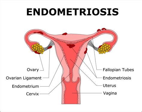 What Is Endometriosis Sunshine State Women S Care Llc