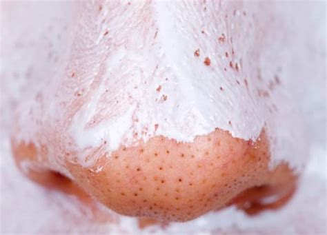 Large Pores On Nose Causes And Ways To Shrink Them Skincarederm