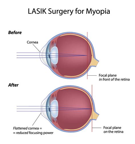 Eyes And Vision As Related To Laser Eye Surgery Pictures