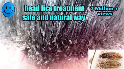Head Lice Treatment The Safe And Natural Wayhow To Remove Lice From
