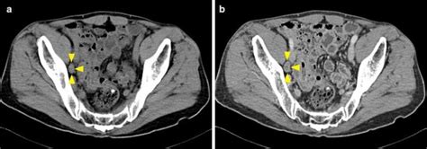 Computed Tomography And Magnetic Resonance Imaging Evaluation Of Pelvic