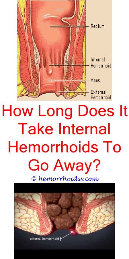 Are Hemorrhoids Hard Or Soft Bleeding Hemorrhoids Hemorrhoid Remedies Hemorrhoids