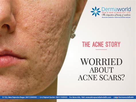 Causes And How To Get Rid Of Acne Scars A Video By Dr Rohit Batra Dermaworld Skin Clinic