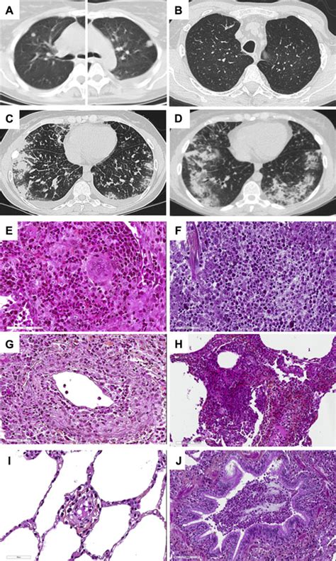 Lung Limited Or Lung Dominant Variant Of Eosinophilic Granulomatosis