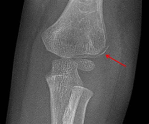 Lateral Femoral Condyle Fracture Images And Photos Finder