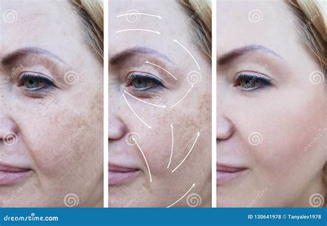 Woman Wrinkles Correction Treatment Before And After Procedures Arrow