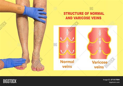 Varicose Veins On Image And Photo Free Trial Bigstock