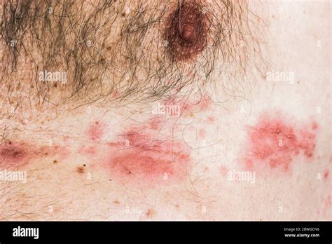hautausschlag von varicella zoster virus auch als gürtelrose auf einem älteren mann bekannt