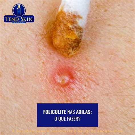 Foliculite Nas Axilas O Que Fazer Dr Foliculite Tend Skin Brasil