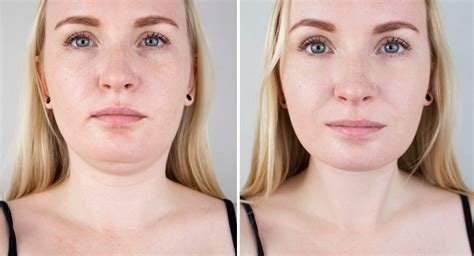 Double Chin Removal Causes Prevention Treatment Dr Donath
