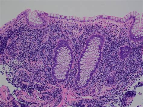 Malt Lymphoma Of The Colon A Clinicopathological Review Journal Of