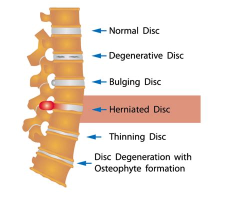 A Herniated Disc What Is It And What Surgical Treatments Are Hot Sex