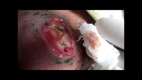 Inflammed Ruptured Sebaceous Cyst On Neck Youtube
