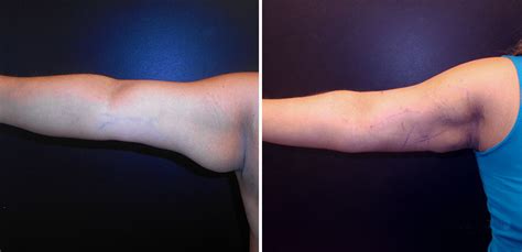 Upper Arm Lipo Before And After Doctorvisit