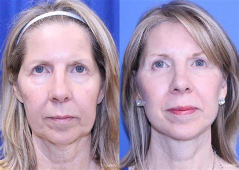 Neck Lift Before And After Gallery