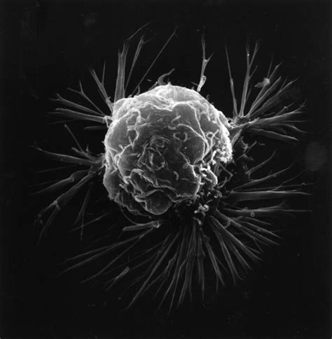 Comprehensive View Of Breast Cancer Reveals New Insights Broad