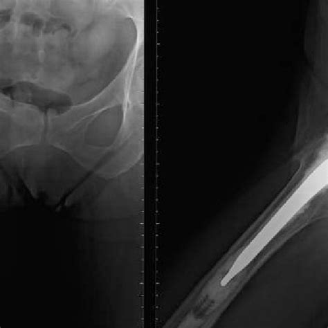 Ap And Lateral Radiographs Of The Right Hip Following Revision