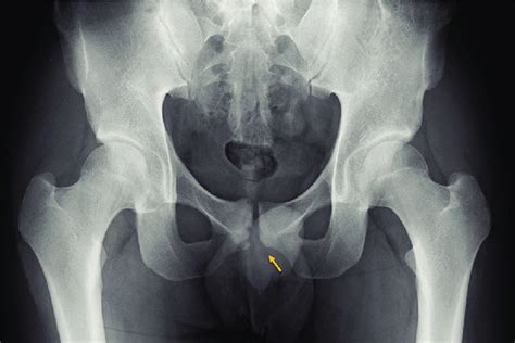 Anteroposterior Pelvic Radiograph Demonstrating Extensive Erosive And