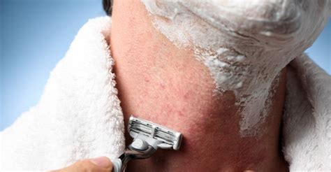How To Get Rid Of Razor Bumps Fast 16 Proven Ways Well Being Secrets