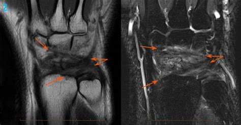 Mri For Hand And Wrist Injuries Melbourne Radiology