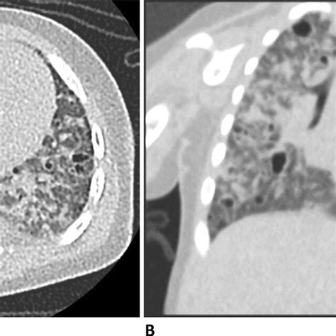 Axial A And Coronal B Ct Chest Without Contrast Show Diffuse
