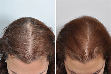 Hair Restoration 22 David Rosenberg Md Pllc