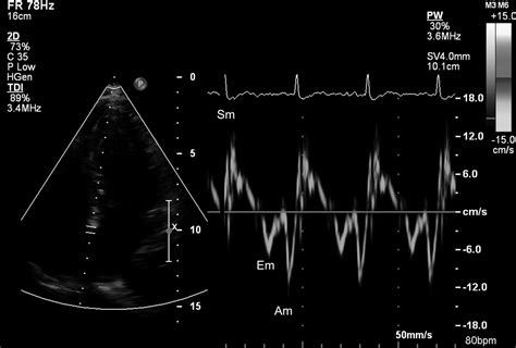 Left Ventricular Diastolic Dysfunction — Early Cardiac Impairment In