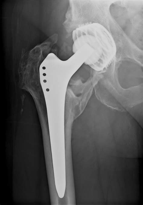 Depuy Metal Hip Implant Lawsuit Filed By Wisconsin Man Top Class Actions