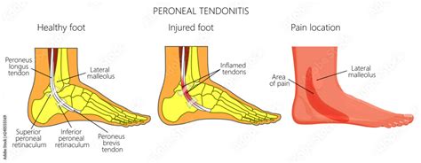 Vector Illustration Of Peroneal Tendon Injuries Peroneal Tendonitis Inflammation Of Peroneal