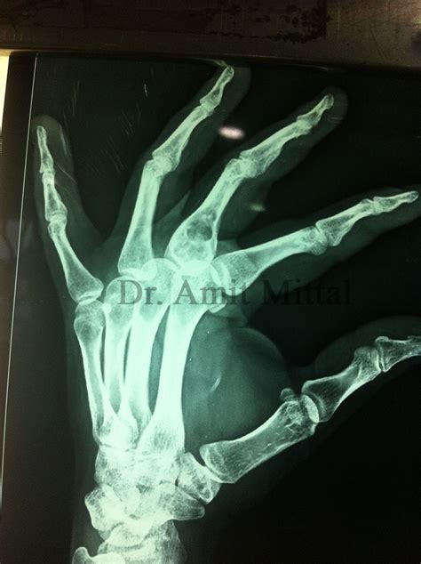 Hand Problems Surgery Sports Injury