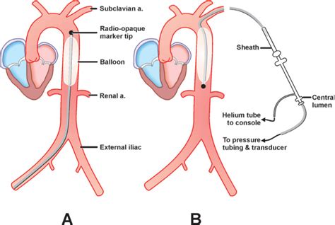 Intra Aortic Balloon Pump IABP Placement Thoracic Key Balloon