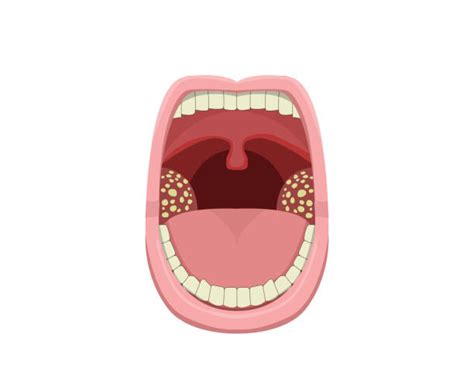 Royalty Free Tonsil Clip Art Vector Images And Illustrations Istock