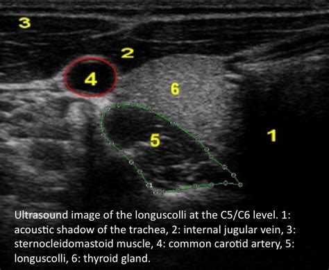 Musculoskeletal Ultrasound Longus Colli Muscle Ultrasound