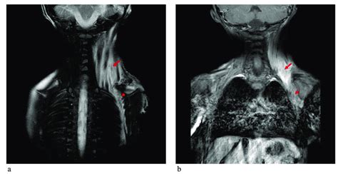 Mri Of The Cervicothoracic Region Of Patient 2 Showing A