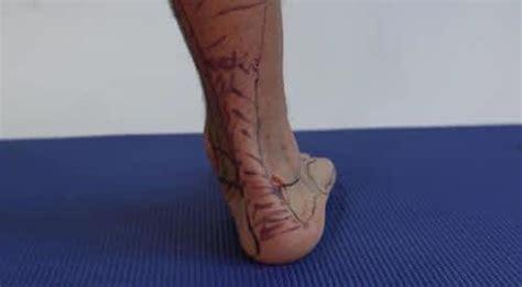 Protruding Bone On Outside Of Foot Causes Symptoms And Best Treatment