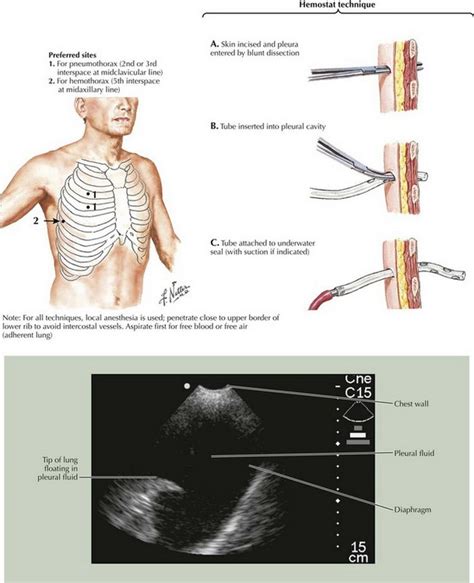 Chest tube insertion is a procedure commonly performed by residents and fellows throughout their general and cardiothoracic surgical training. Chest Tube Placement | Basicmedical Key