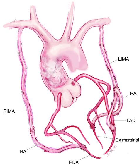 Illustration Of Bilateral Internal Mammary Artery Grafts Rima Right